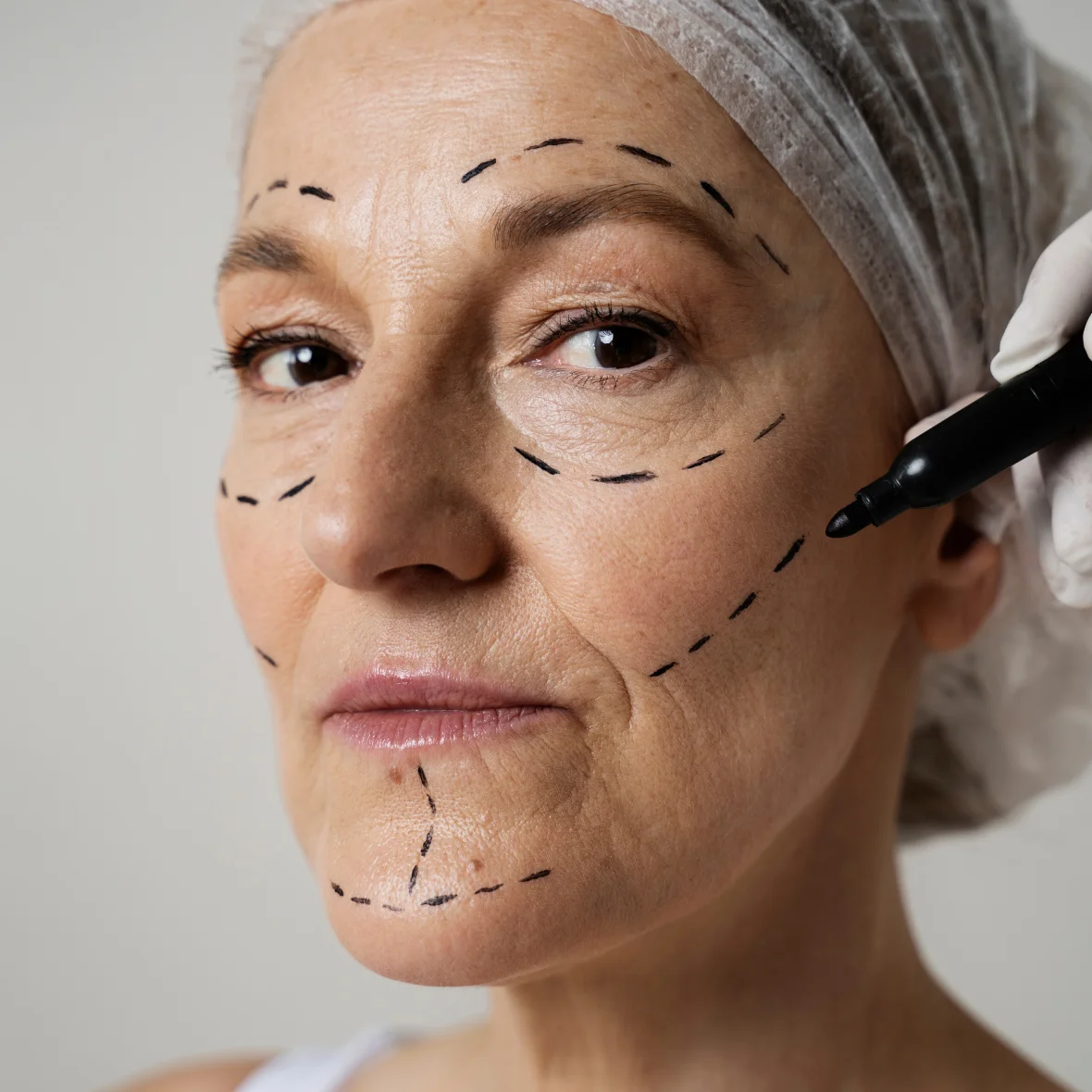 Tracé préopératoire d'un lifting du visage - Dr Jauffret, Marseille